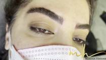 میکروبلیدینگ در تهران در مرکز فیبروز مریم حیدری
