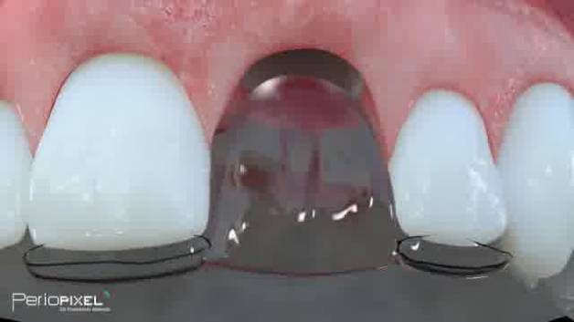 ایمپلنت دندان و پیوند لثه